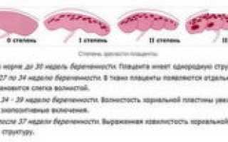 Плацента 3 степени зрелости на 33 неделе