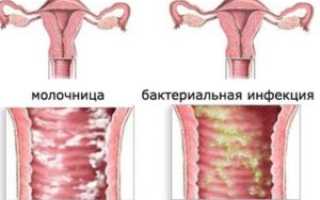 Молочница при зачатии последствия