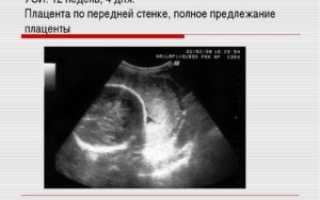Низкая плацентация по узи