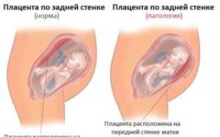 Плацента расположена высоко по передней стенке матки