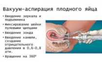 Антибиотики после вакуумной аспирации