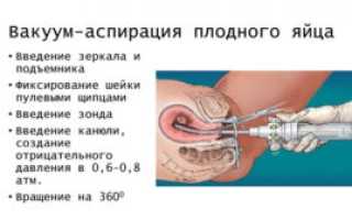Антибиотики после вакуумной аспирации